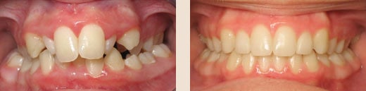 Before and after Wilson & Kim Orthodontics in Novato, CA