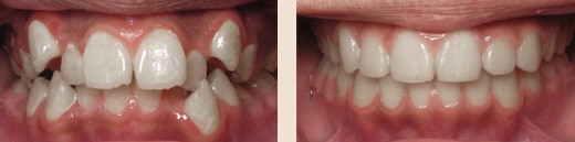 Before and after at Wilson & Kim Orthodontics in Novato, CA