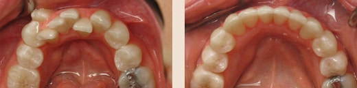 Before and After Wilson & Kim Orthodontics in Novato, CA