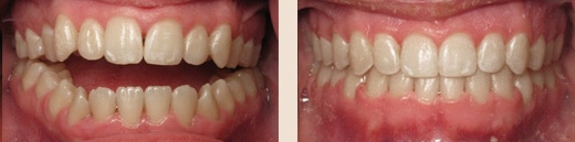 Before and after Wilson & Kim Orthodontics in Novato, CA